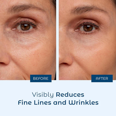How To Get Rid Of Wrinkles Around Mouth With A Simple Routine